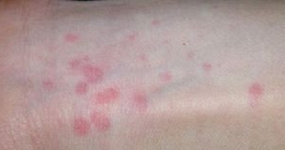 手腕丘疹性荨麻疹症状图片
