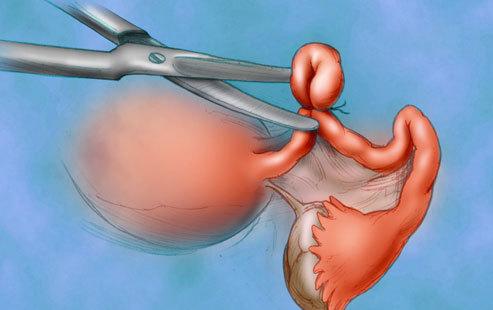 输卵管结扎可降低患病风险