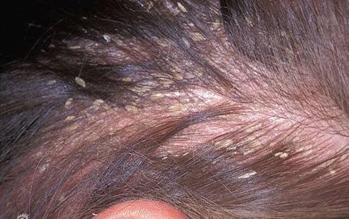 虽然脂溢性皮炎与激素,真菌甚至某些神经疾病有关,但仍可使用去屑洗发