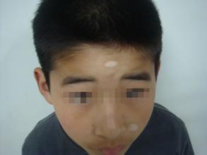 儿童白癜风要怎么治疗
