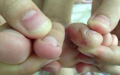 脚总是脱皮怎么办 脚总是脱皮怎么办