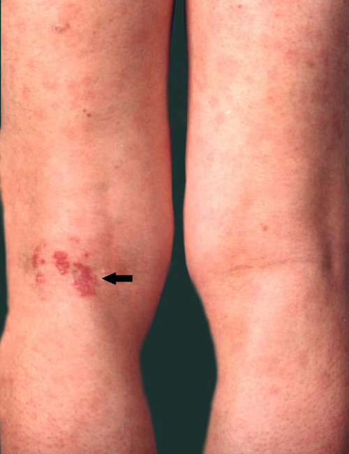 下肢斑疹性二期梅毒疹图片