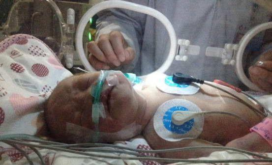 女醫生急中生智 用自制呼吸機救活嬰孩