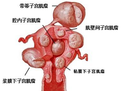 子宮肌瘤不切除就會癌變嗎？