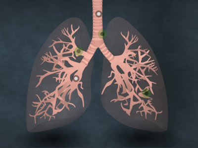 肺癌真的是被“氣”出來的病