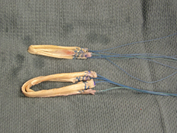 前十字韧带断裂图片