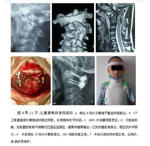 难复性寰枢椎脱位的外科治疗