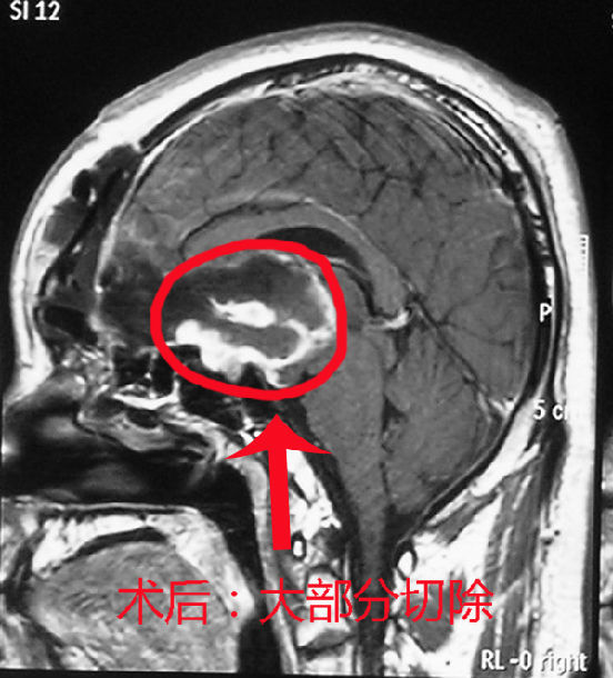 冠切右额开颅鞍区胶质瘤切除是怎样的?