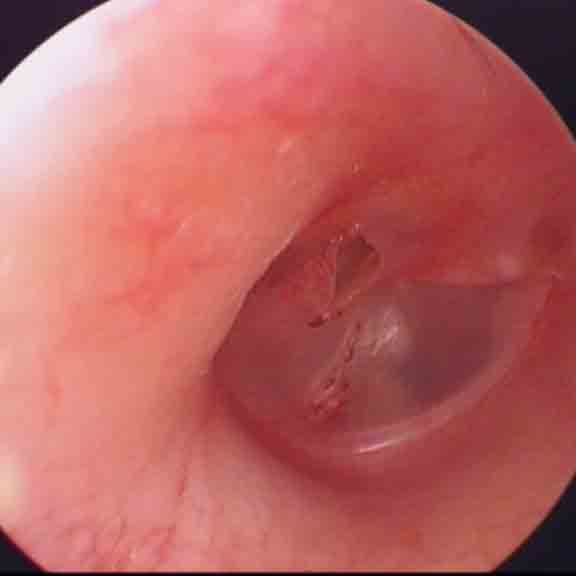 鼓膜穿孔耳内镜检查(附图片)