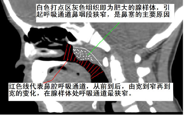 腺样体肥大的临床表现