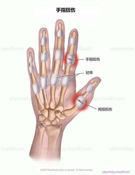 fins-手指扭伤康复如何练习