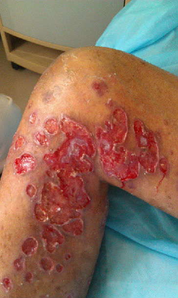 皮肤结核分枝杆菌感染1例