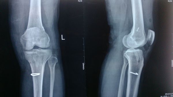 韧带断裂手术费用图片