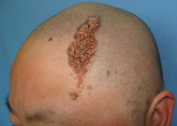 图3青春期损害增厚扩大,表面呈乳头瘤样隆起.