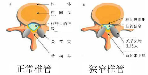 腰椎管狭窄症 与腰椎间盘突出症 一样吗(转载)