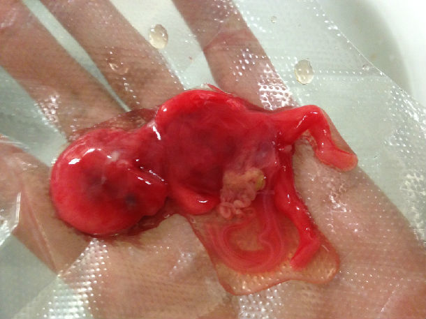 (1)孕12周前的早期流产开始时绒毛与蜕膜剥离,血窦开放,出现阴道流血