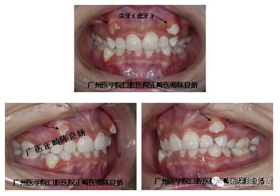 拯救倒霉的"小虎牙"