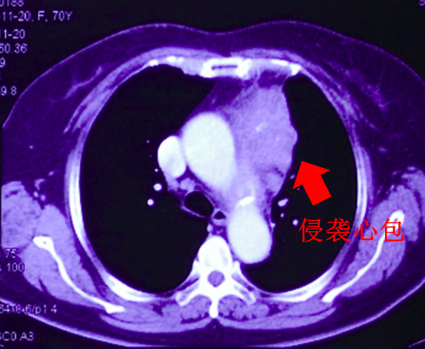 胸部CT