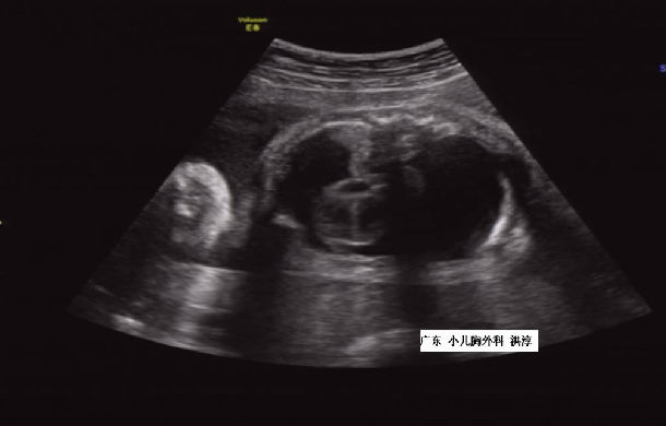 胎儿,胸腔积液…准妈妈们了解吗?