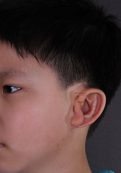 注水扩皮全包法耳郭再造--手术瘢痕最轻的耳郭