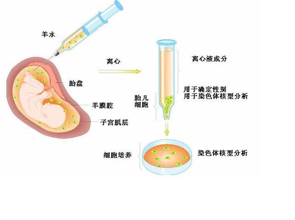 什么是羊膜腔穿刺?对胎儿损伤的风险大吗?