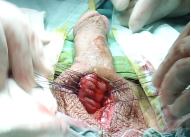 但纵切口较易解剖海绵体,切口不宜过小,影响手术视野.