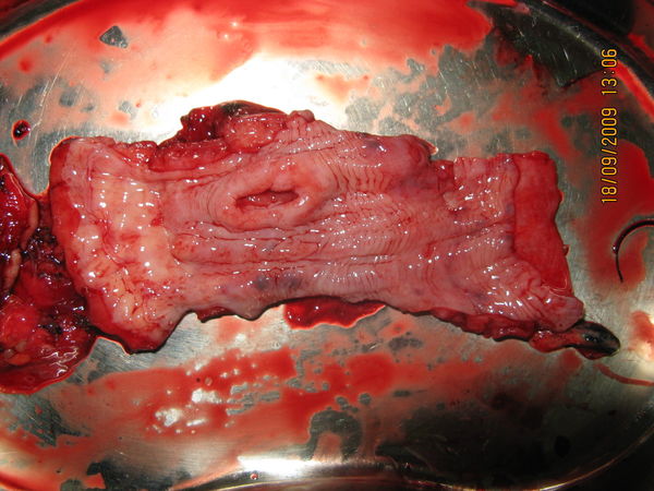 食管癌,肺癌切除术标本照片