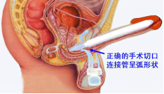 全面了解阴茎支撑体(假体)手术之二 ――手术方法简介