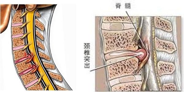 交感神经型颈椎病第八节 颈椎间盘突出症|颈椎