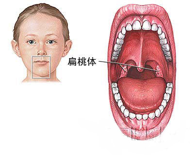 扁桃体切除术