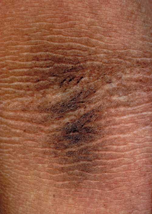 角化性皮肤病图谱