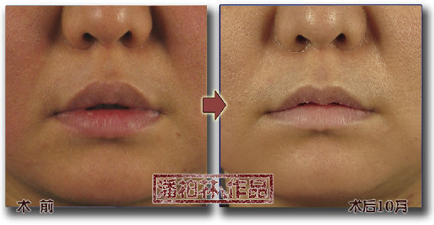 厚唇/重唇修薄整形手术_潘柏林_中华康网