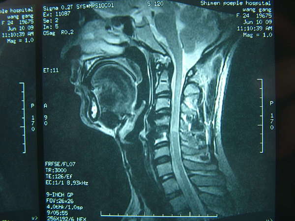颈椎前路手术治疗脊髓型颈椎病疗效影响因素分