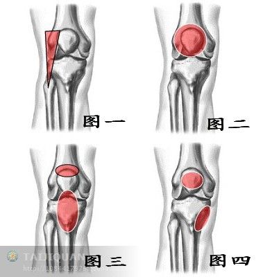 髌前滑囊炎:曾有外伤史,引起髌前疼痛,查体局部有压痛.