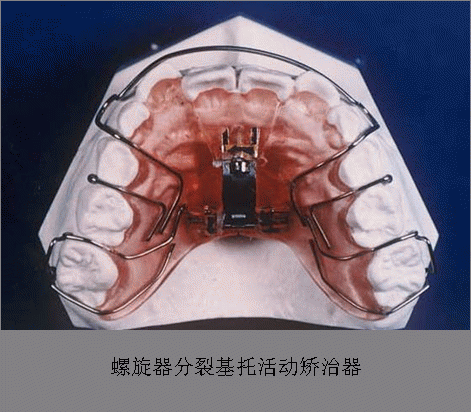 医生文章 详情 下面简要介绍一下几种常用的治疗"地包天"的矫正器