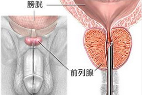 前列腺炎13.png