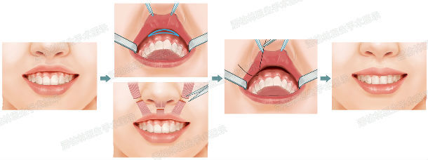 "露龈笑"整形手术