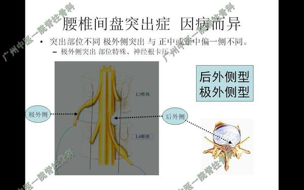 二,腰椎间盘突出的部位 ―― 腰椎神经根从椎管分出后经神经根管走出