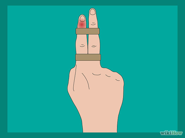 手把手教程:手指戳伤的处理原则(转载)