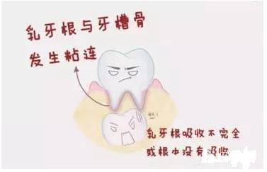 使乳牙根吸收不完全或根本没有吸收,造成乳牙不能脱落