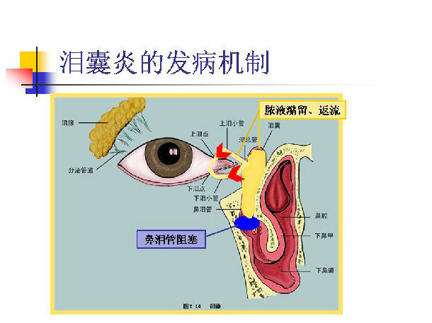 表现为溢泪,溢脓,指压泪囊区有脓性分泌物自泪囊经泪小管返流进入结膜