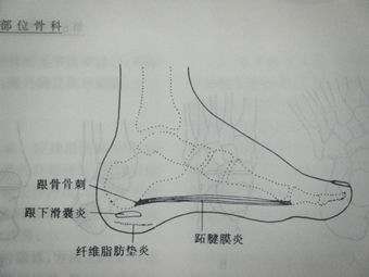 (图2)而行走时骨刺也会刺激跟下滑囊导致跟下滑囊炎引起足跟疼痛.