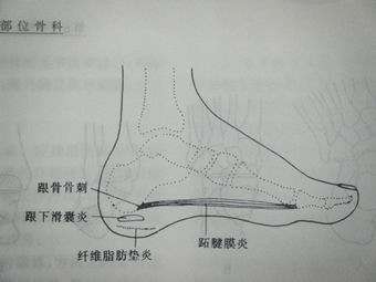 关于跖腱膜炎患者,下列哪项是错误的