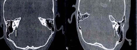 大前庭导水管综合征的CT影像学诊断_吴佩娜