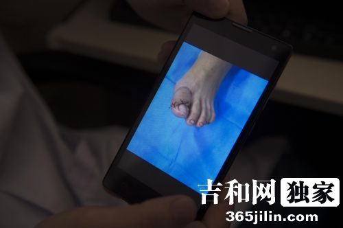 松原新娘婚礼前夜脚趾被钢管戳断 答谢宴成新郎独角戏