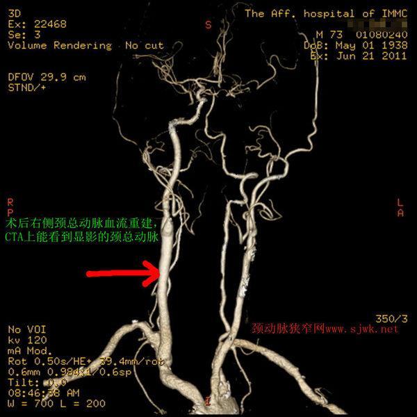 颈动脉闭塞,手术成功再通(附图)