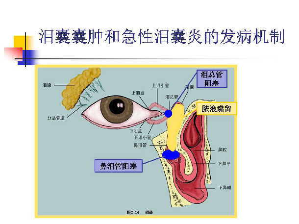 四,泪囊囊肿和急性泪囊炎