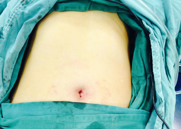 "无疤痕"腹腔镜手术――单孔腹腔镜胆囊切除
