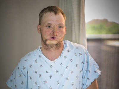 男子因抑郁症吞枪自杀致毁容 11年后重获新脸