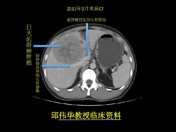 根治性切除联合索拉菲尼成功治疗原发性特大肝癌_邱伟华_中华康网